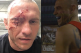 donald cerrone eye